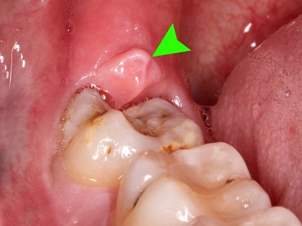 pericoronitis